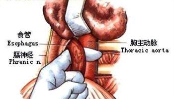 也有人把它叫做贲门炎的,其实,贲门是食道进入胃的门户,贲门炎多发生