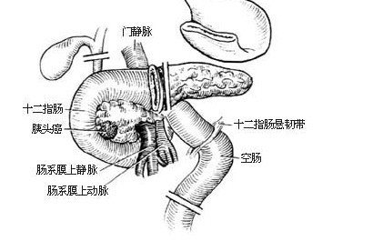 十二指肠息肉应该挂什么科